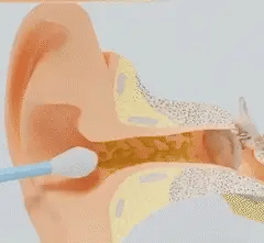HD Ear Cleaning Tool